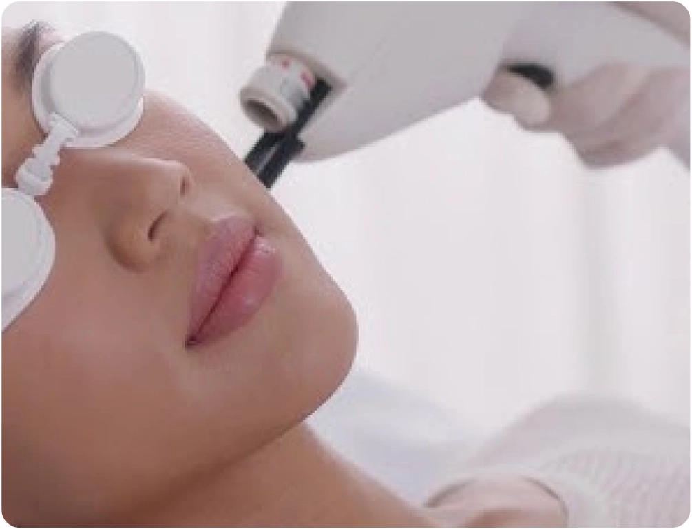 Laser Acne Therapy: A Modern Solution for Clearer Skin and Lasting Results